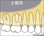 上顎洞と歯の位置